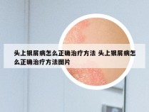 头上银屑病怎么正确治疗方法 头上银屑病怎么正确治疗方法图片