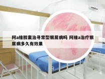 阿a维胶囊治寻常型银屑病吗 阿维a治疗银屑病多久有效果