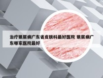 治疗银屑病广东省皮肤科最好医院 银屑病广东哪家医院最好