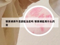 银屑病用牛舌舔能治愈吗 银屑病能用什么药膏
