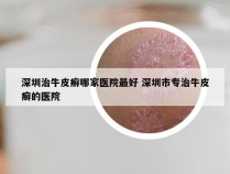 深圳治牛皮癣哪家医院最好 深圳市专治牛皮癣的医院