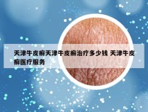 天津牛皮癣天津牛皮癣治疗多少钱 天津牛皮癣医疗服务