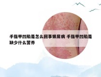 手指甲凹陷是怎么回事银屑病 手指甲凹陷是缺少什么营养