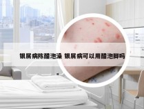 银屑病陈醋泡澡 银屑病可以用醋泡脚吗