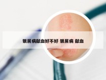 银屑病献血好不好 银屑病 献血