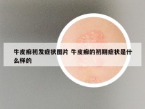 牛皮癣初发症状图片 牛皮癣的初期症状是什么样的