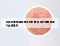 点滴型银屑病能用激素后果 点滴型银屑病用什么抗生素