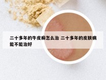 二十多年的牛皮癣怎么治 二十多年的皮肤病能不能治好