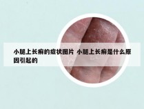 小腿上长癣的症状图片 小腿上长癣是什么原因引起的