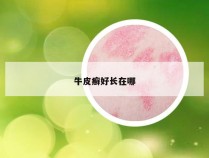 牛皮癣好长在哪