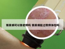 银屑病可以做老师吗 银屑病能过教师体检吗