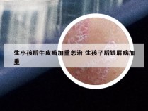 生小孩后牛皮癣加重怎治 生孩子后银屑病加重
