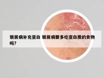 银屑病补充蛋白 银屑病要多吃蛋白质的食物吗?