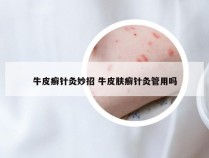牛皮癣针灸妙招 牛皮肤癣针灸管用吗