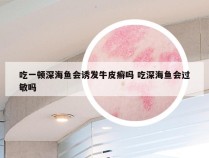 吃一顿深海鱼会诱发牛皮癣吗 吃深海鱼会过敏吗