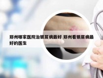 郑州哪家医院治银屑病最好 郑州看银屑病最好的医生