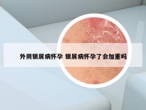 外阴银屑病怀孕 银屑病怀孕了会加重吗