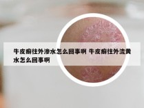 牛皮癣往外渗水怎么回事啊 牛皮癣往外流黄水怎么回事啊