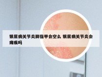 银屑病关节炎脚指甲会空么 银屑病关节炎会瘫痪吗