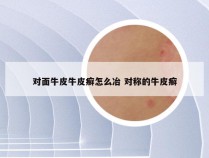 对面牛皮牛皮癣怎么冶 对称的牛皮癣