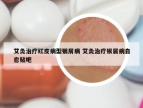 艾灸治疗红皮病型银屑病 艾灸治疗银屑病自愈贴吧
