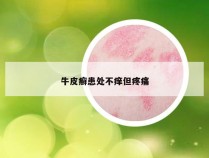 牛皮癣患处不痒但疼痛