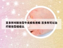 百多邦对脓包型牛皮癣有用嘛 百多邦可以治疗脓包型痘痘么