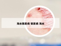 海水银屑病 银屑病 海水