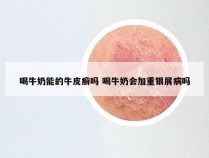 喝牛奶能的牛皮癣吗 喝牛奶会加重银屑病吗