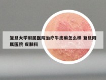 复旦大学附属医院治疗牛皮癣怎么样 复旦附属医院 皮肤科