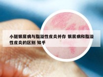 小腿银屑病与脂溢性皮炎并存 银屑病和脂溢性皮炎的区别 知乎