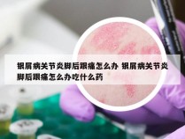银屑病关节炎脚后跟痛怎么办 银屑病关节炎脚后跟痛怎么办吃什么药