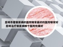 昆明市看银屑病的医院哪家最好的医院哪家好 昆明治疗银屑病哪个医院效果好