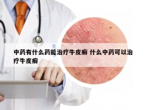 中药有什么药能治疗牛皮癣 什么中药可以治疗牛皮癣