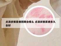 点滴状银屑病初期会痒么 点滴状银屑病多久会好