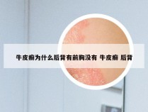 牛皮癣为什么后背有前胸没有 牛皮癣 后背
