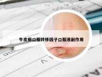 牛皮癣口服转移因子口服液副作用