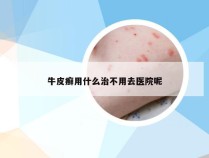 牛皮癣用什么治不用去医院呢