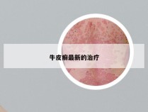 牛皮癣最新的治疗