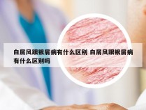 白屑风跟银屑病有什么区别 白屑风跟银屑病有什么区别吗
