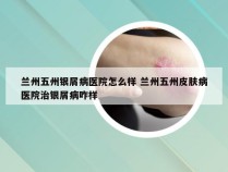 兰州五州银屑病医院怎么样 兰州五州皮肤病医院治银屑病咋样