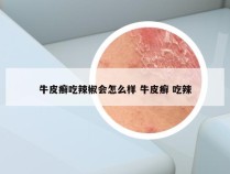 牛皮癣吃辣椒会怎么样 牛皮癣 吃辣