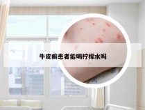 牛皮癣患者能喝柠檬水吗