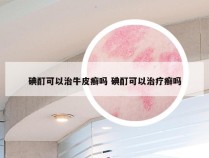 碘酊可以治牛皮癣吗 碘酊可以治疗癣吗