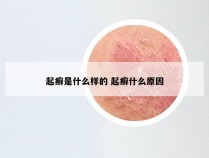 起癣是什么样的 起癣什么原因