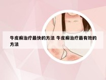 牛皮癣治疗最快的方法 牛皮癣治疗最有效的方法