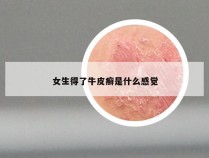女生得了牛皮癣是什么感觉