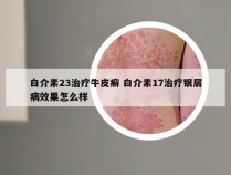 白介素23治疗牛皮癣 白介素17治疗银屑病效果怎么样