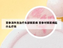 苦参汤外洗治疗头部银屑病 苦参对银屑病起什么疗效