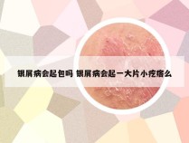 银屑病会起包吗 银屑病会起一大片小疙瘩么
